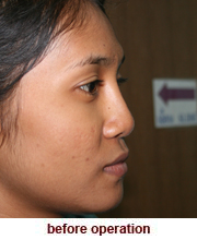 plastic_surgery_augmentation_rhinoplasty